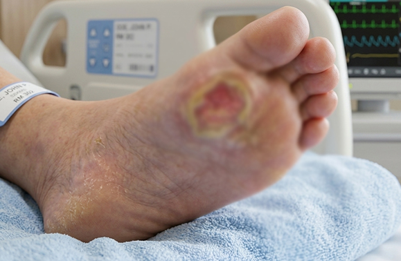 diyabetik ayak yarası